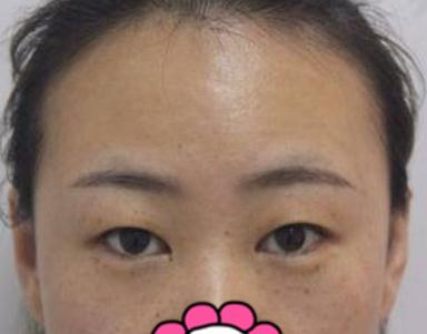 埋線雙眼皮手術的果圖&nbsp;及過程解析圖