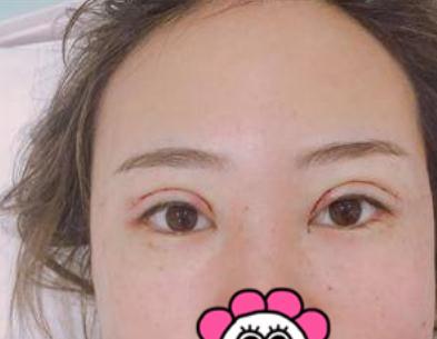 埋線雙眼皮術后第4天