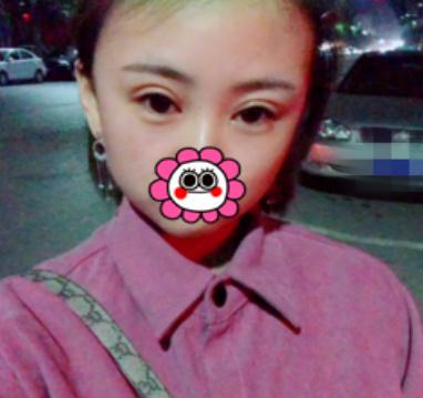 埋線雙眼皮術后第13天