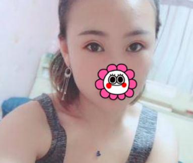 埋線雙眼皮術后第34天