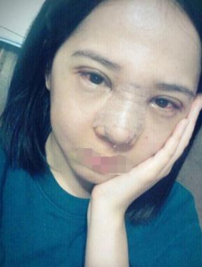 雙眼皮手術(shù)前的準(zhǔn)備