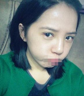 雙眼皮手術(shù)術(shù)后第34天