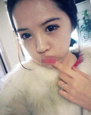 雙眼皮手術(shù)術(shù)后第45天