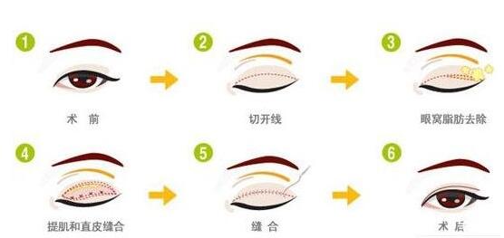 埋線雙眼皮術后第13天