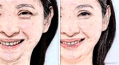 去魚尾紋的方法有哪些？