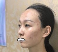 妹子做果酸換膚對(duì)比圖~嫩膚界的愛馬仕~