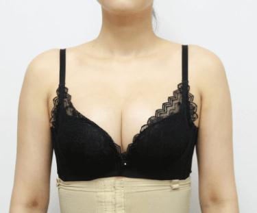 隆胸術(shù)前準(zhǔn)備