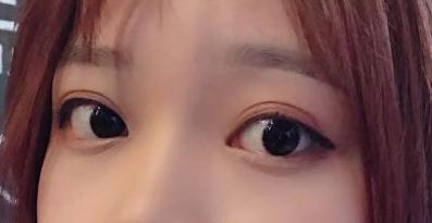 雙眼皮手術(shù)術(shù)后第12天