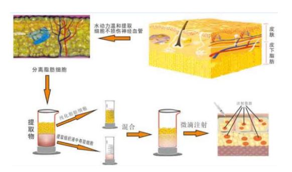 自體脂肪豐臀的手術(shù)原理