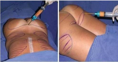 恢復(fù)需要多長(zhǎng)時(shí)間?