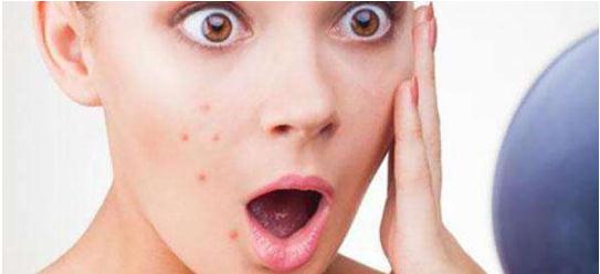 女生下巴長痘是壓力過大嗎？