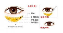 整理調(diào)節(jié)眼袋的方法幾種方法！看你適合哪一種
