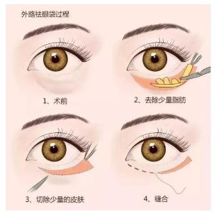 吸脂祛眼袋