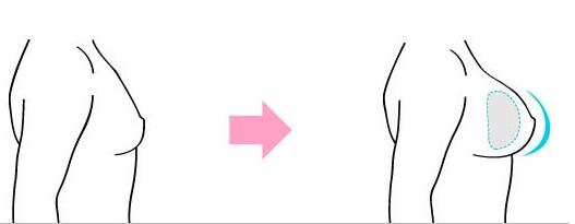 適合圓形假體的人群