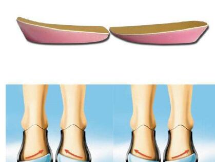 什么方法可以糾正X形腿?