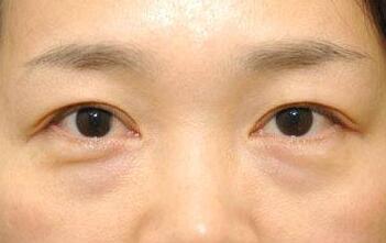 超聲波眼袋摘除術(shù)