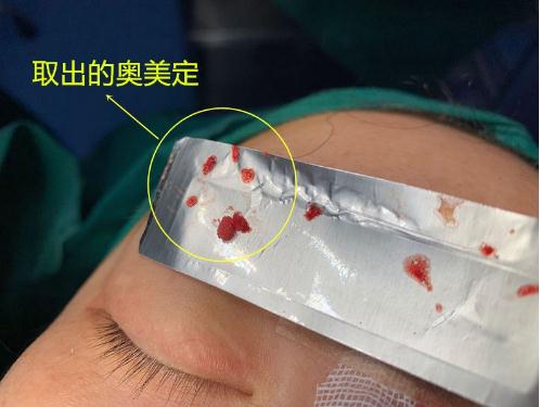 注射奧美定之后有什么癥狀?