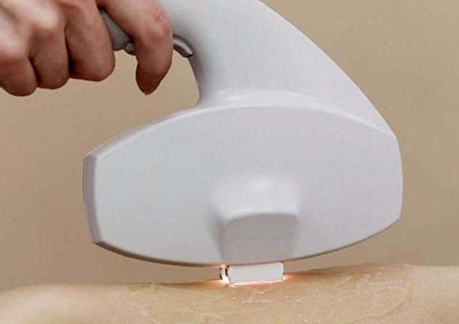 腋窩*脫毛多少錢？