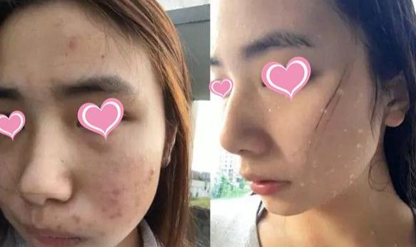 痘星人做像素激光去痘簡直太靠譜了，果圖