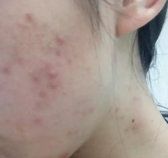 痘星人做像素激光去痘簡直太靠譜了，果圖