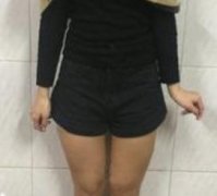 做完大腿部吸脂塑形手術(shù)后，p圖軟件都閑置了