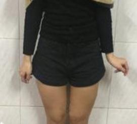 做完大腿部吸脂塑形手術(shù)后，p圖軟件都閑置了