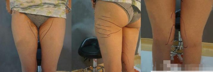 大腿吸脂手術(shù)術(shù)前