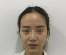 玻尿酸豐嘴唇真實(shí)感受~這才是豐唇正確打開方式