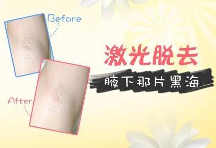 激光脫毛的副作用