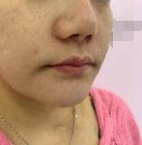 豐唇手術(shù)術(shù)前