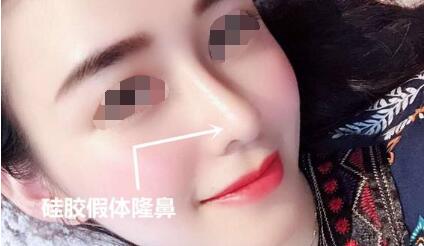 硅膠隆鼻的果怎么樣？