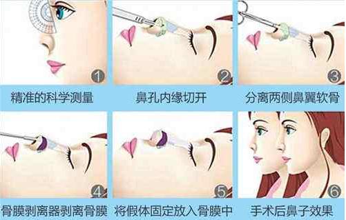 隆鼻手術(shù)怎么做？詳細(xì)流程介紹一下