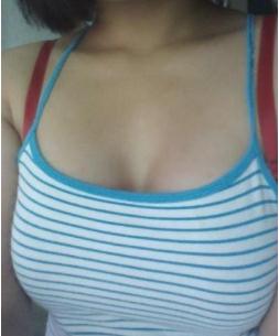 取出假體后的胸部會變丑嗎?