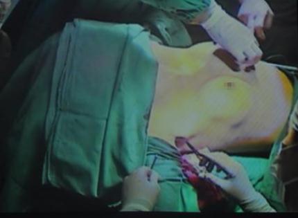 假體隆胸取出假體的注意事項