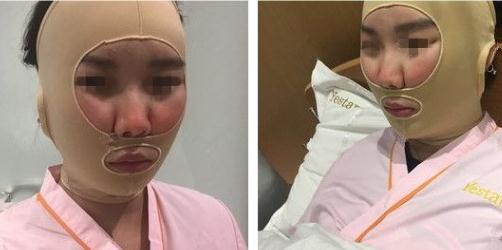 面部吸脂術(shù)后