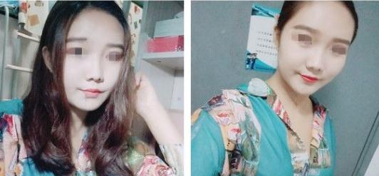 面部吸脂術(shù)后第45天