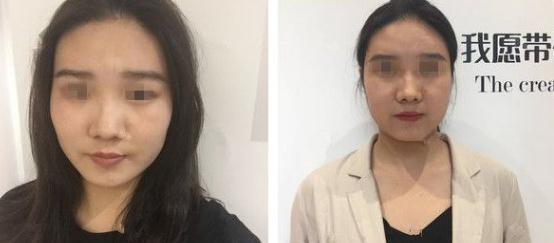 在南京藝星做面頰部吸脂！抽了90ml的脂肪！