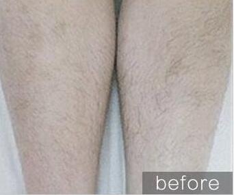 冰點脫毛的原理