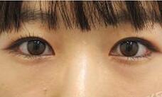 對(duì)于我們每個(gè)人來(lái)說(shuō)首先要明白有沒(méi)有必要開(kāi)外眼角?