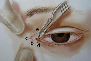 外眼角開(kāi)大后是可以進(jìn)行縫合修復(fù)的~