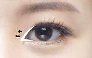 外眼角開(kāi)大后是可以進(jìn)行縫合修復(fù)的~