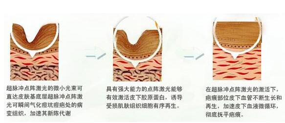 激光去痘印的危害有哪些？