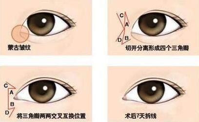 開眼角手術(shù)的壞處