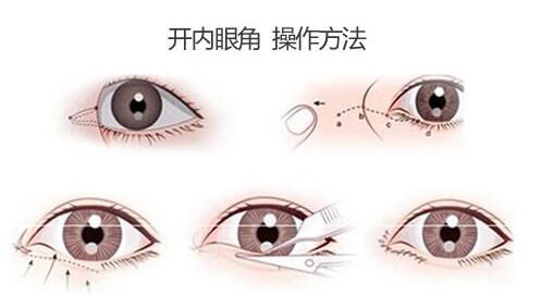 開眼角手術(shù)的壞處