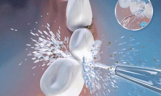 什么是牙結(jié)石?