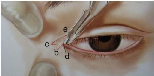 開眼角手術(shù)的壞處
