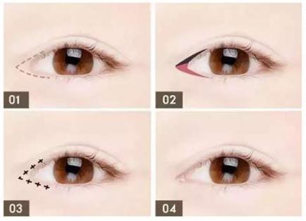 開眼角手術(shù)后的注意事項