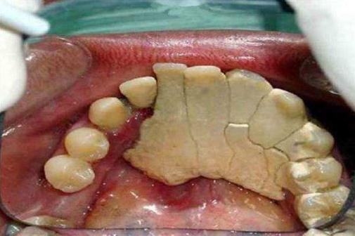 什么是牙結(jié)石?