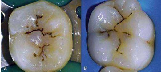 什么是色素沉積的牙齒?