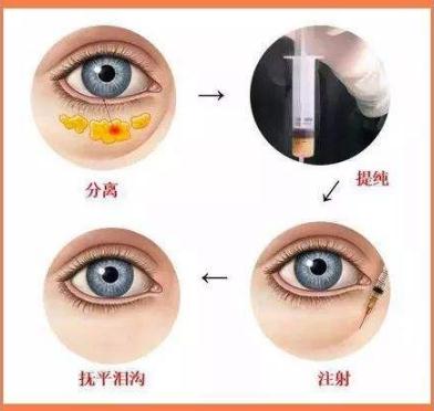 淚溝的祛除方法